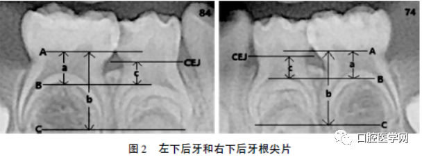 乳磨牙牛牙症1例病例报告及文献综述