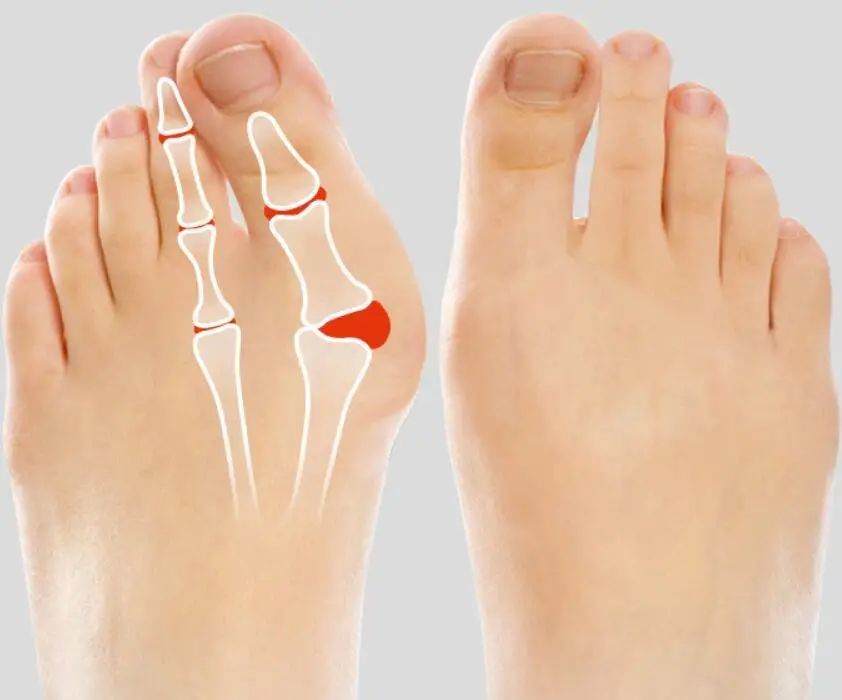 直播预告丨脚趾竟越长越歪?外翻的预防及矫正
