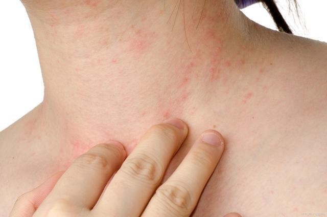 是什么意思特应性皮炎最大的特征就是呈皮肤干燥,慢性湿疹样皮损和