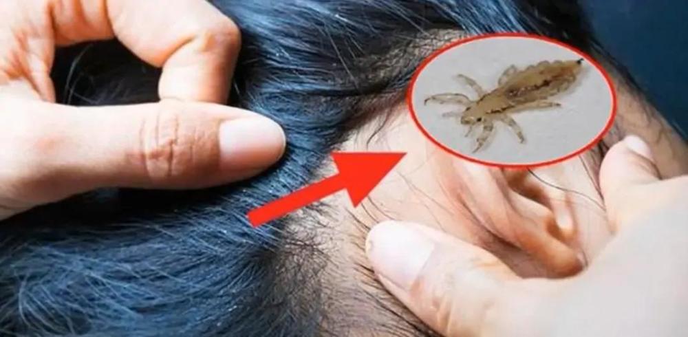 陪伴人类最久的生物,30年前随处可见,为何现如今看不到虱子了?