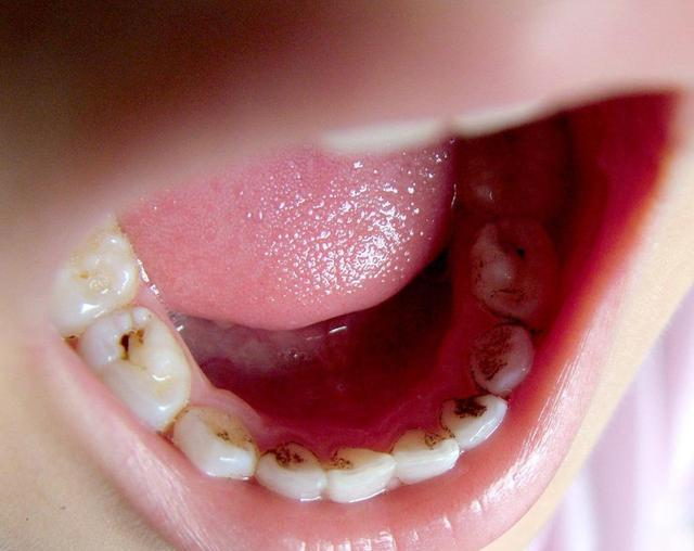 入园体检后才发现,10个孩子7个牙齿有问题