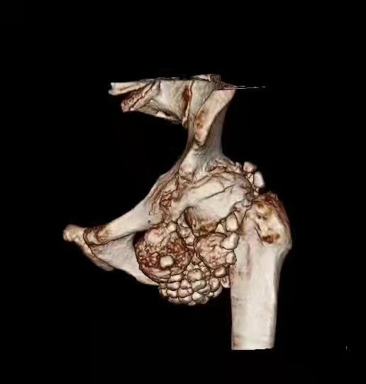 一男子髋关节取出70粒"关节鼠" 最大的有鹅蛋大