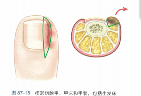 距趾甲侧缘4-5mm处,通过一椭圆形皮肤切口做楔形组织切除;加深切口的
