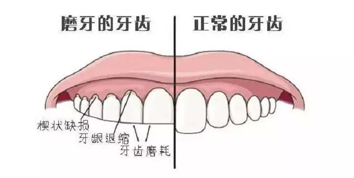 千万不要忽视磨牙,长期磨牙可引发大问题!