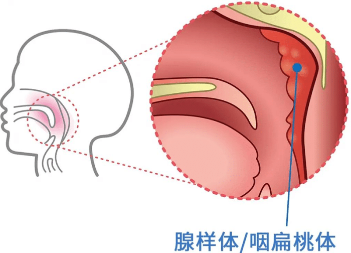 现在小孩为什么得腺样体肥大的那么多