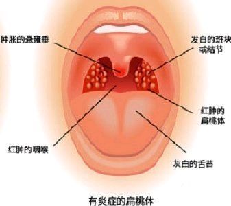 暨南大学崇爱医院耳鼻喉专科李俊泉医师讲解扁桃体炎的饮食注意