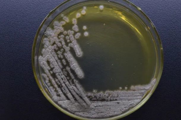 孢子丝菌引起上肢皮肤软组织慢性感染病例分析