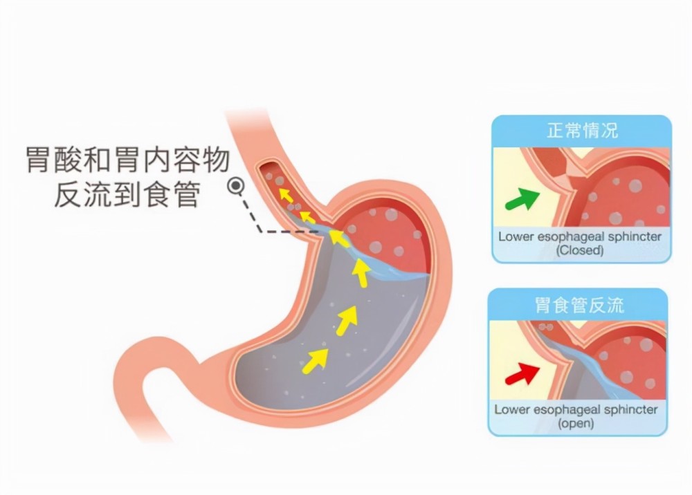 不一定!可能是胃食管反流病!