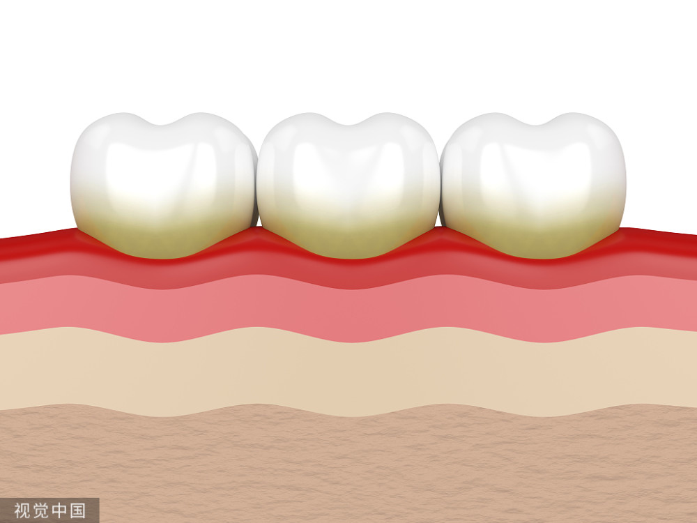 牙龈出血对口腔的影响 牙龈炎,牙周炎不仅会出现牙龈出血现象,随着
