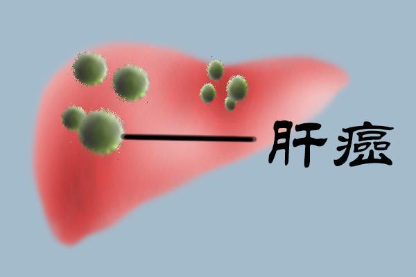肝癌到了晚期一般还能活多久是继续治疗还是放弃治疗