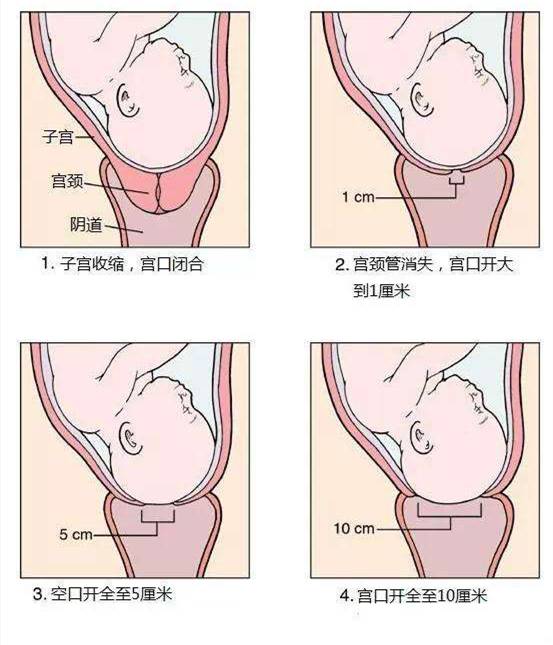 开宫口是有一个循序渐进的过程.