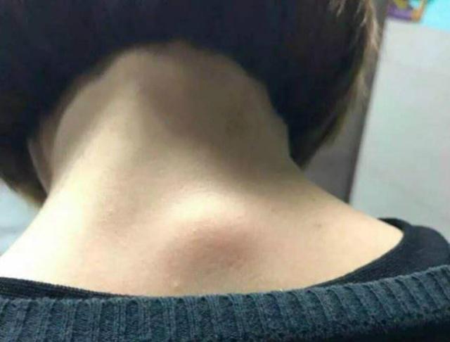 如若脖子后面有一个大包,由于这个大包长出非常异常,很多人担心是肿瘤