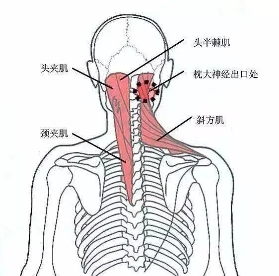 枕大神经卡压主要引起枕后疼痛,呈针刺样或者刀割样放射性痛,主要位于