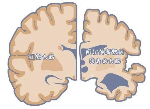 世界阿尔兹海默病日!别等疾病夺走亲人的记忆再开始后悔