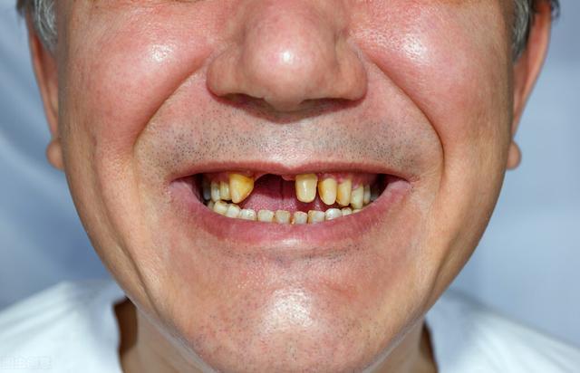 老年人一般多少岁开始掉牙牙齿脱落后需要注意什么