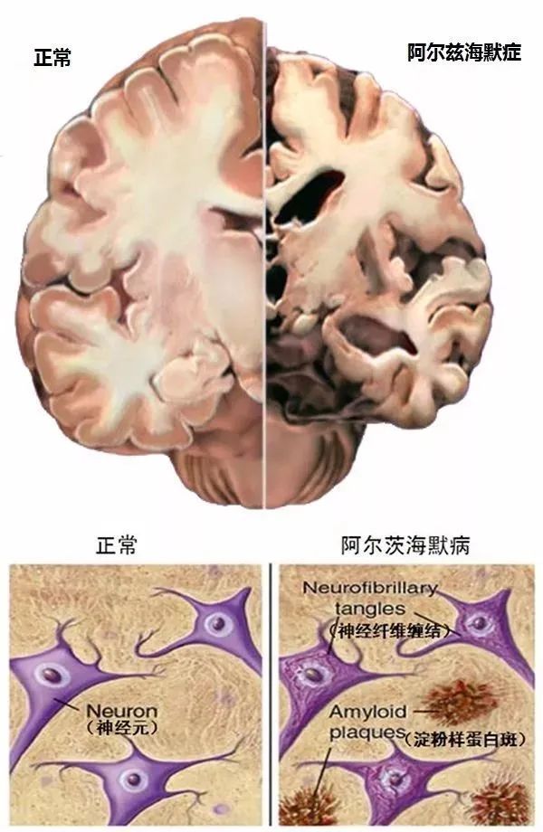 ibrainscience今天是中秋节也是阿尔茨海默病日