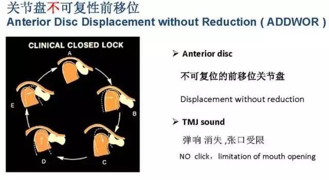 颞下颌关节盘移位(本文转载自:朱耀旻颞颌关节及颌面整形工作室公众号