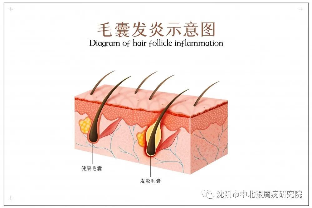 反复发作的毛囊炎到底该怎么办建议先看生长部位和发生原因