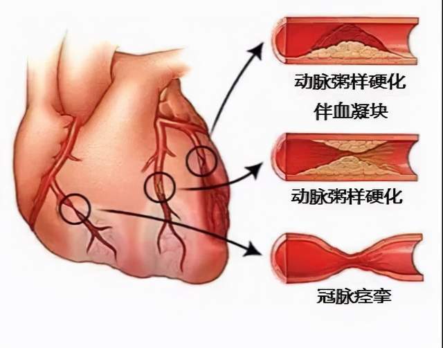 26岁退役军人每天严格要求自己为什么依然患有冠心病