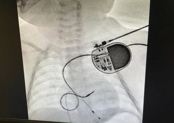 2个月大,再破纪录!湖北省内最小先心儿植入心内膜永久起搏器