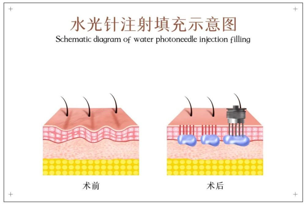 这两种成分是美白针的组成部分,所以,加入这两种成分的水光针会有美白