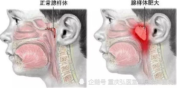 咽后壁附有炎性脓性分泌物,鼻咽部指诊可触和鼻咽顶后壁有柔软的淋巴