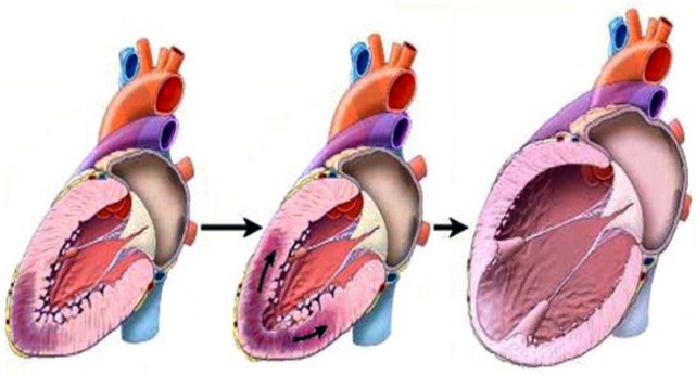 高血压患者出现"左心室肥厚",就是到了心脏病的转折点!
