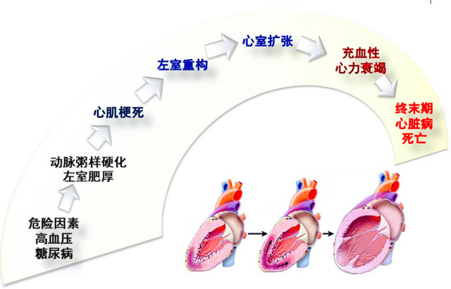 高血压患者出现"左心室肥厚",就是到了心脏病的转折点!