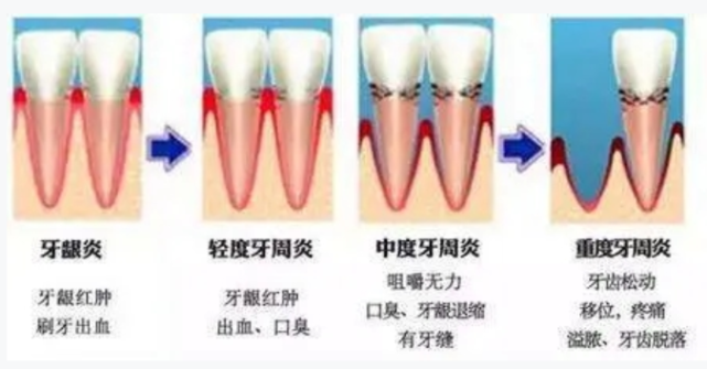 牙周炎是什么原因引起的?口腔师总结预防和治疗根源
