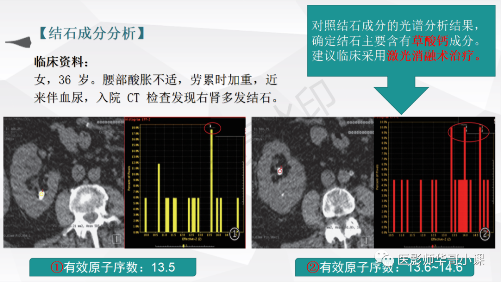【ct课件】gsi能谱ct成像的临床应用