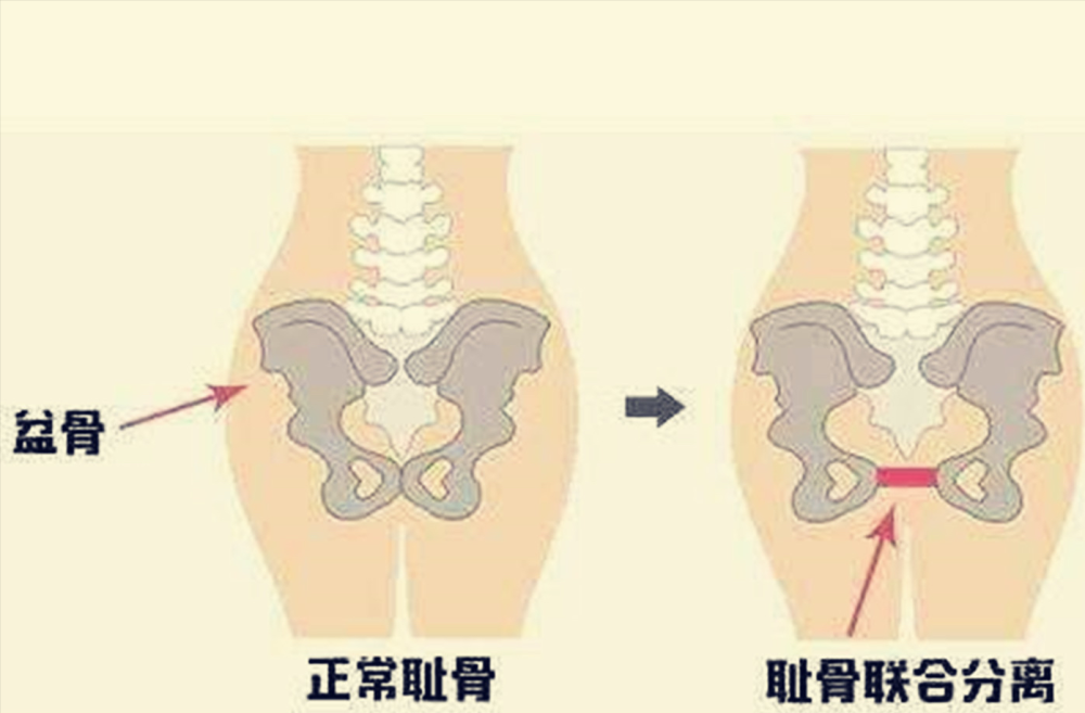 孕晚期耻骨联合疼怎么办