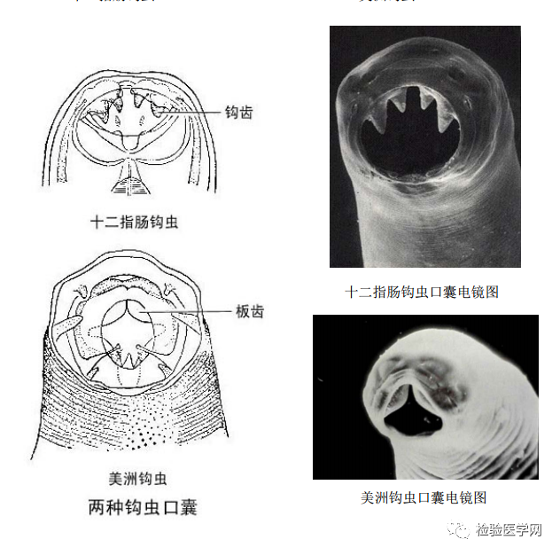 (3)婴幼儿钩虫病:母亲在妊娠时感染了钩虫,幼虫经胎盘