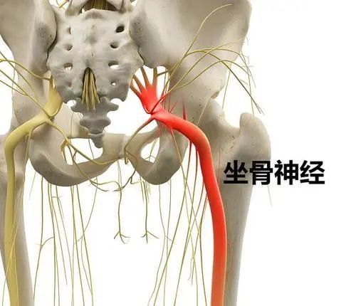 3,坐骨神经痛主要表现为患者经过一段距离行走后,下肢会出现酸麻胀痛