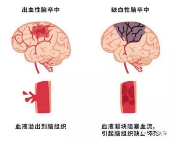 脑卒中患者救治过程会经历什么?yb1溶栓技术或成就下一代抗血栓神药