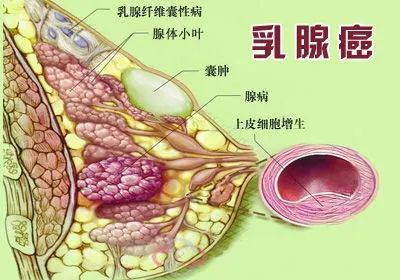 健康随行丨乳腺癌容易赖上哪些人?