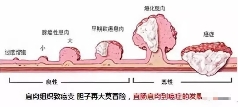 等症状而被医生看到 小儿的直肠息肉,因为易出血而从肛门脱出而露出