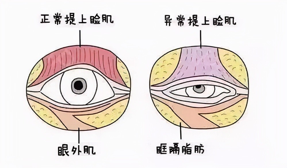 上眼睑肌无力怎么办?