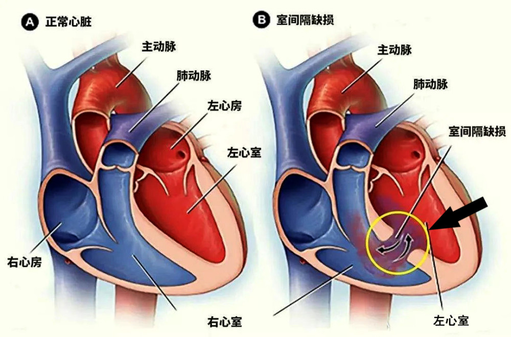 心脏内四个房间的大小需要维持在正常的比例,心脏才能健康地跳动.
