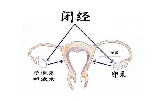 闭经是妇科疾病中常见的症状,闭经可以由各种不同的原因引起.