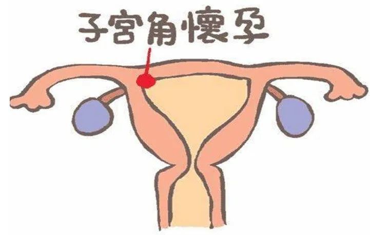 是指受精卵着床于子宫与输卵管开口交界处的子宫角部的妊娠,胚胎向宫
