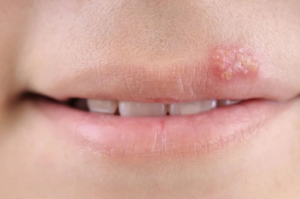 "烂嘴角"口角炎烂嘴角对应的问题是口角炎,病因有细菌感染,真菌感染