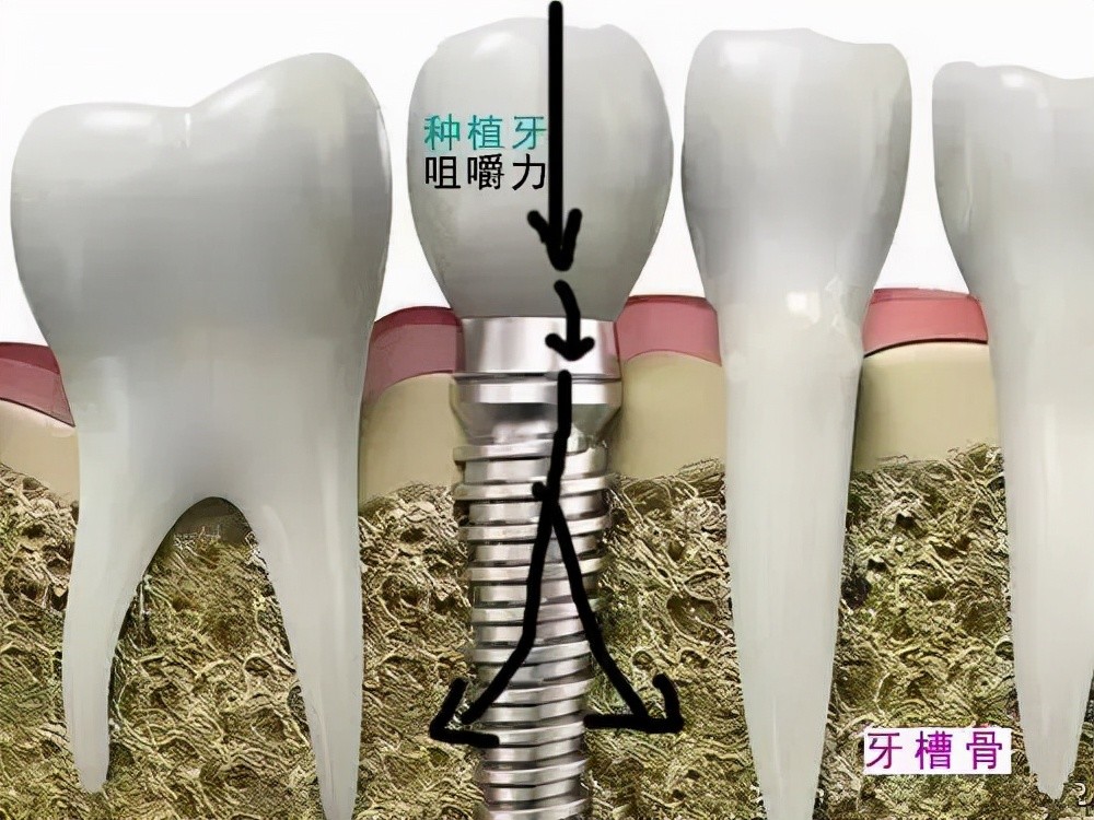 牙齿缺失后,陷入镶牙or种牙之间难以抉择?良心牙医告诉你怎么选