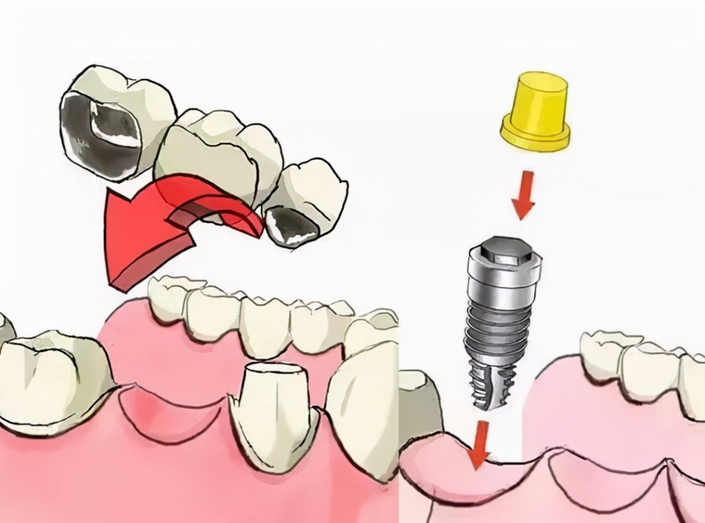 牙齿缺失后陷入镶牙or种牙之间难以抉择良心牙医告诉你怎么选