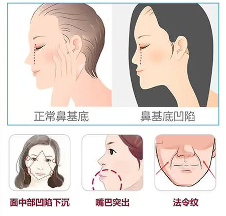 面相的几种类型:a,直面型 b,微凸型 c,凸面型 d,凹面性颜值的排序就