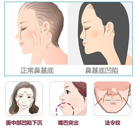 颜值杀手鼻基底凹陷可以这样做