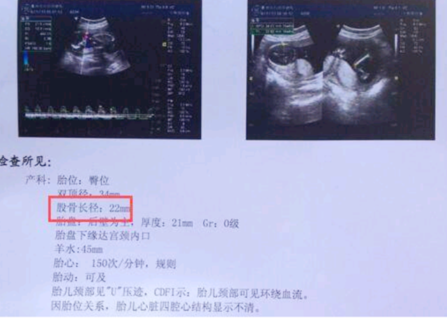 2)胎儿的双顶径比较大大部分情况下,男孩子要比女孩子的身高高一些