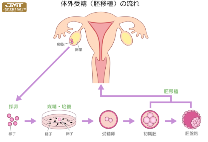 体外受精胚胎移植流程~收集的卵子和精子结合制成受精卵并转移到子宫