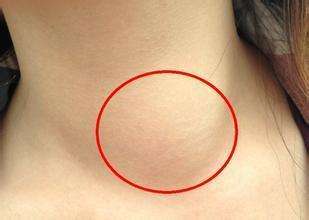 甲状腺结节也会癌变甲状腺王克珍专家警惕这3个症状