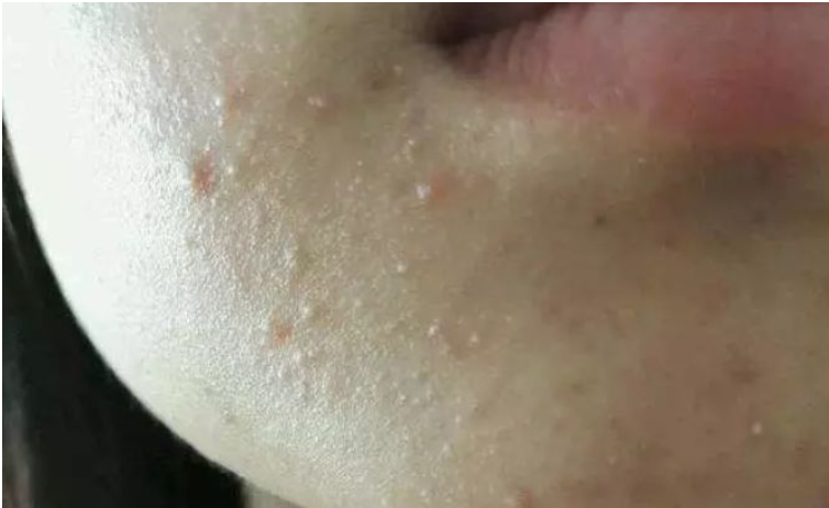 逆光疹假闭口怎么拯救对症护理才能事半功倍