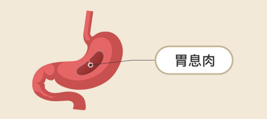 胃息肉又是怎么回事?和肠息肉一样?